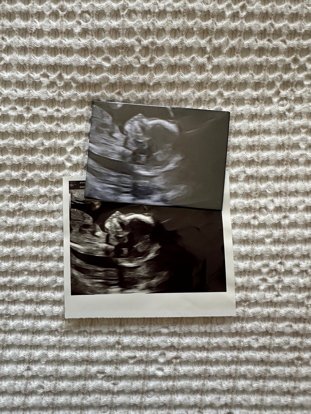 Custom Ultrasound Magnet | Preserve Your Baby’s First Photo